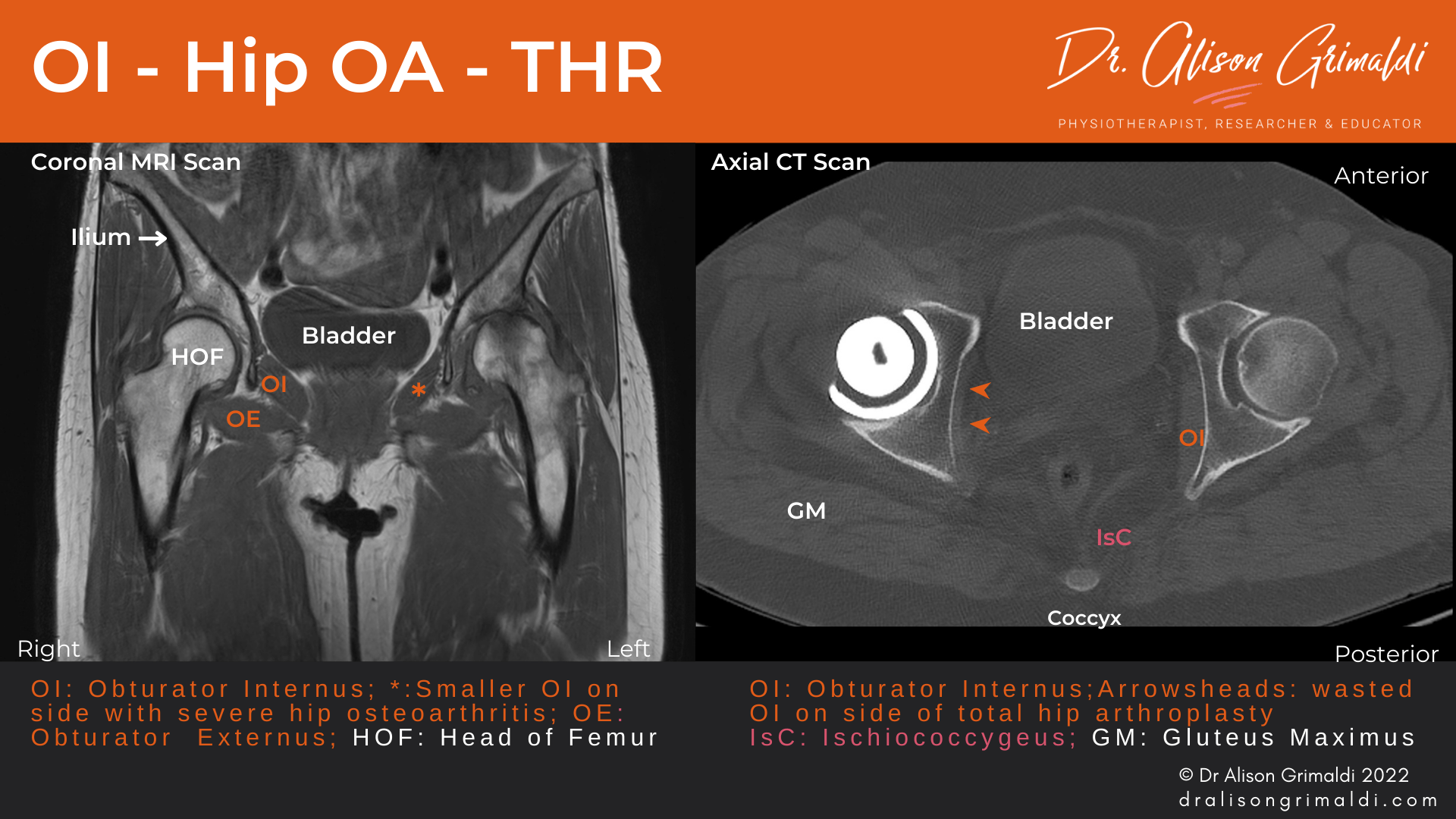 MRI and CT Scan of Obturator Internus in Hip OA and after Hip Replacement