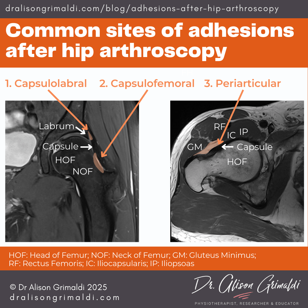Common-sites-of-adhesions-after-hip-arthroscopy