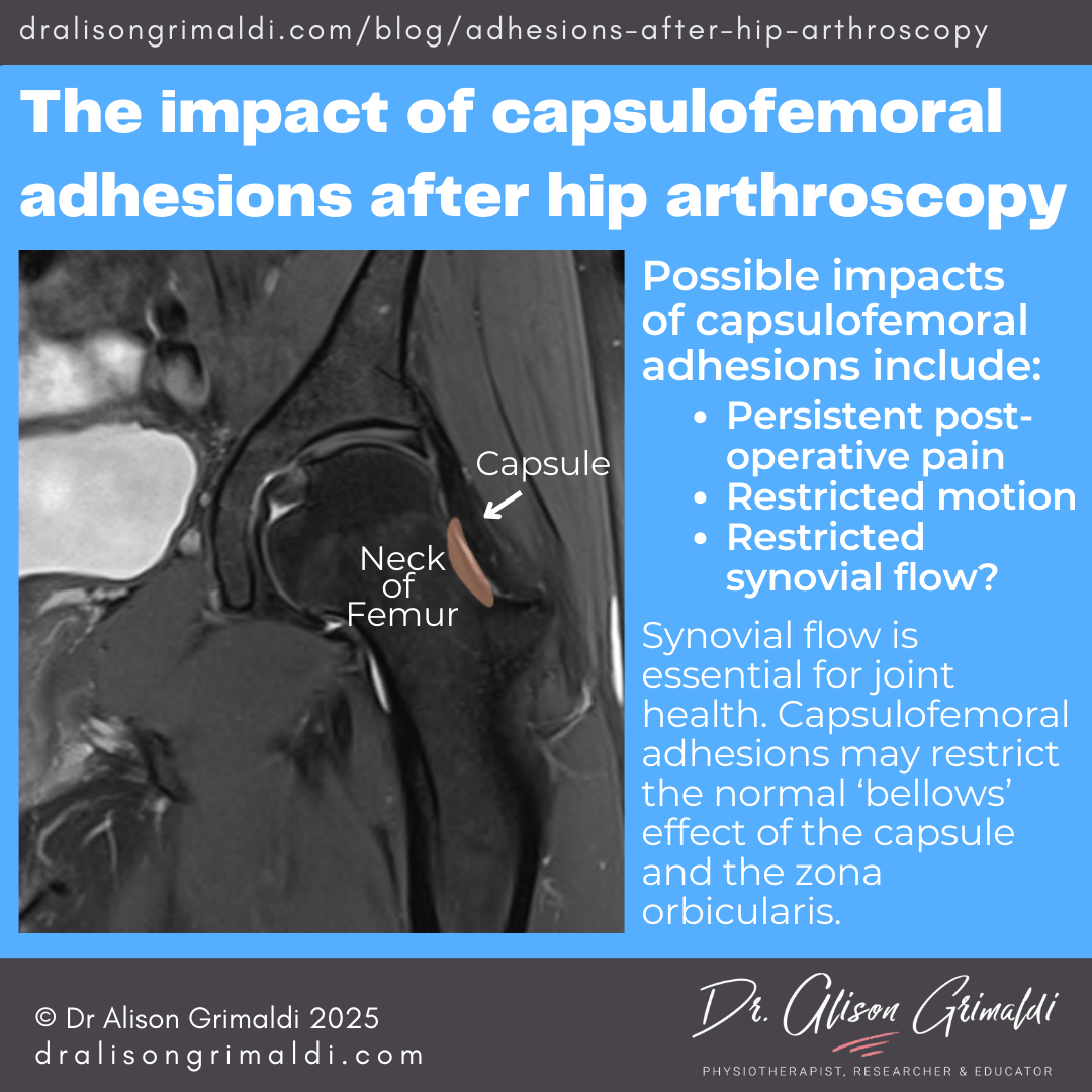 The-impact-of-capsulofemoral-adhesions-after-hip-arthroscopy