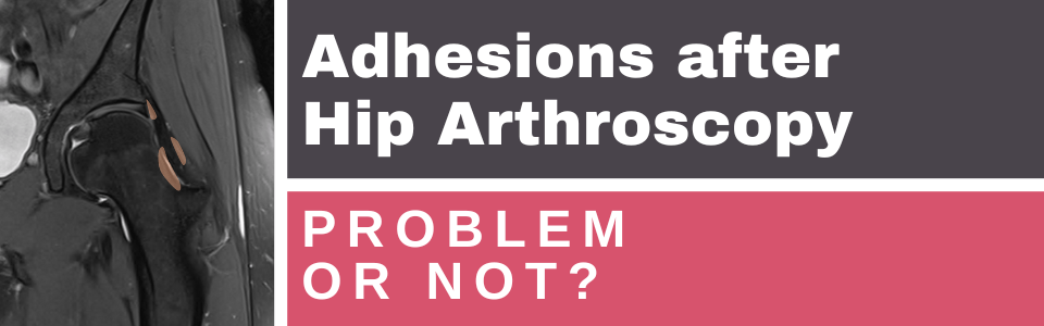 adhesions-after-hip-arthroscopy-prevention-&-treatment