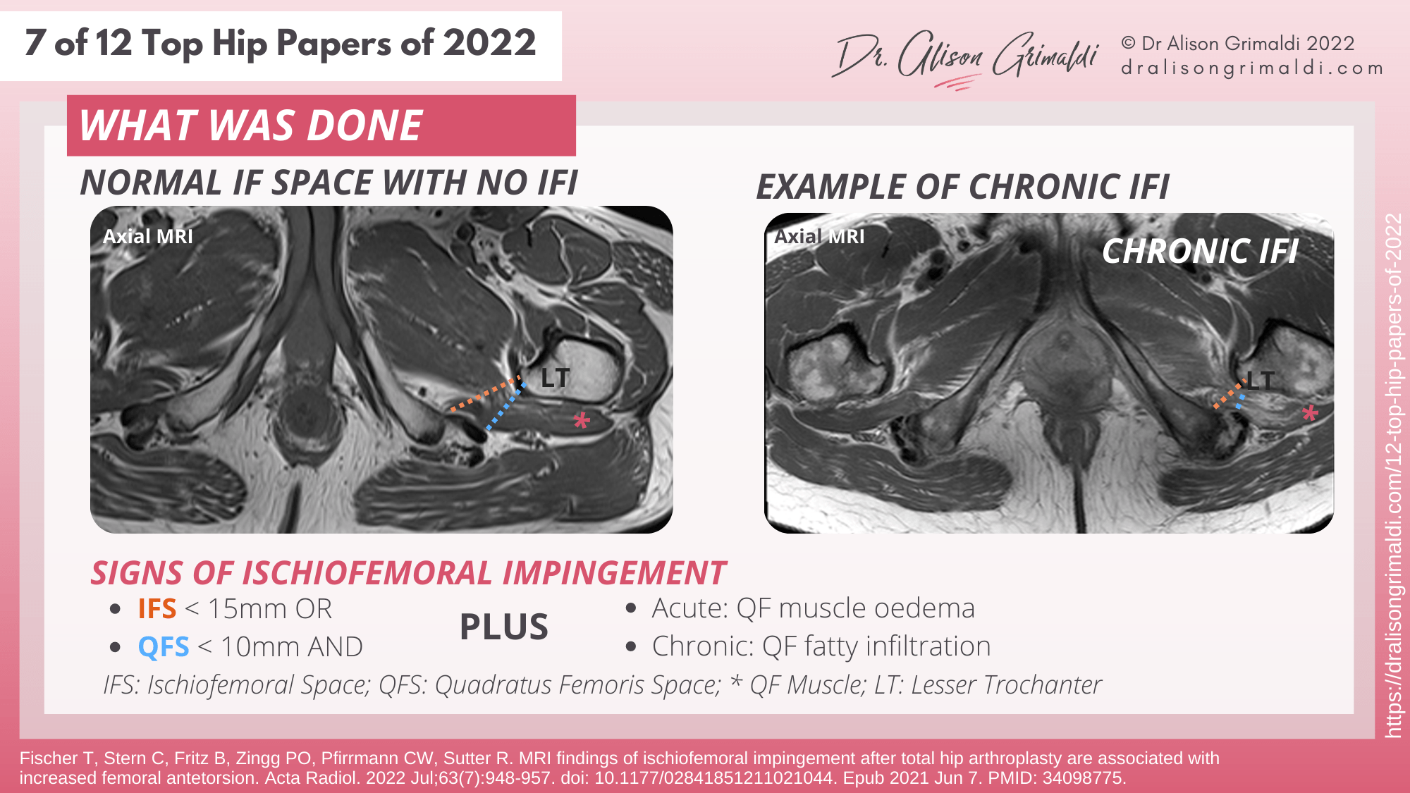 What Was Done - 7 of 12 - IFI, surgery, total hip arthroplasty, total hip replacement