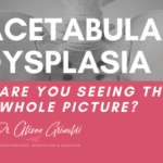 Acetabular Dysplasia - are you seeing the whole picture?