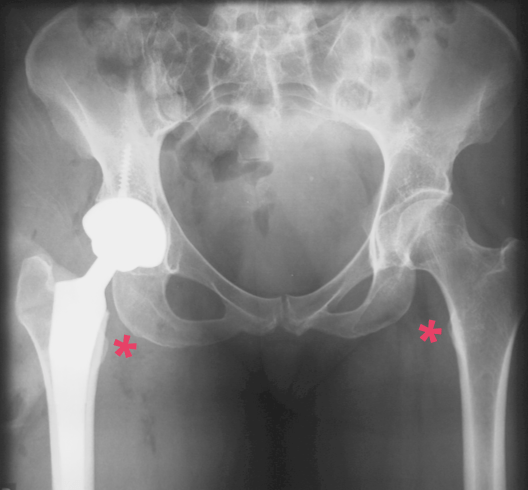 Impingement of the QF muscle