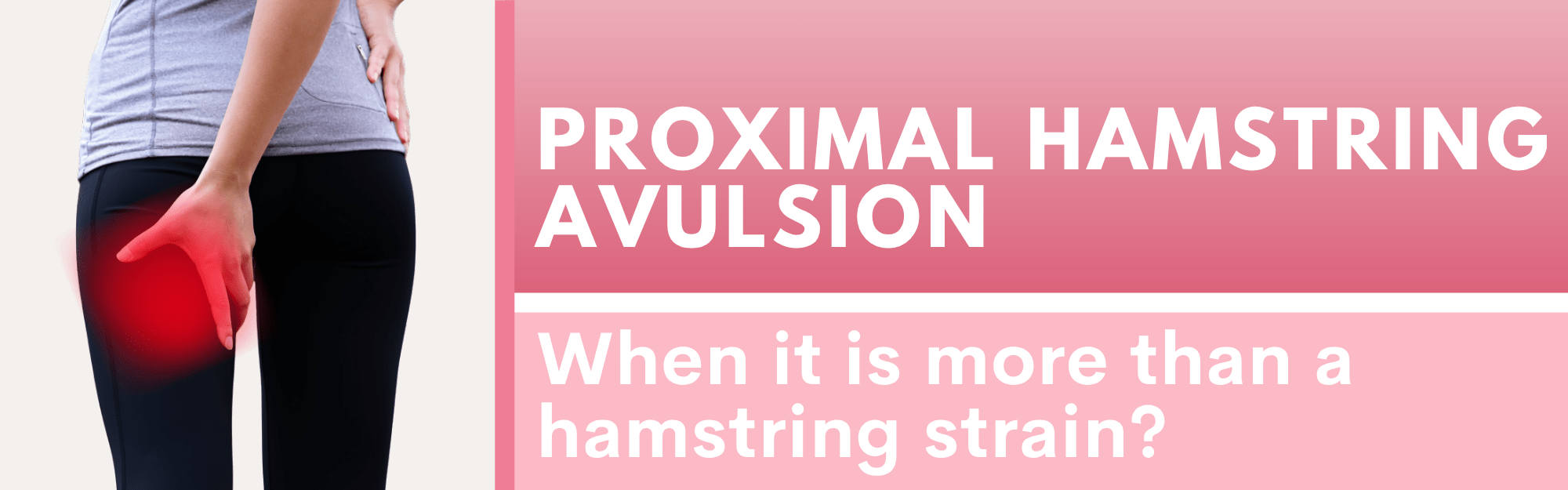 proximal-hamstring-avulsion-when-it-is-more-than-a-hamstring-strain