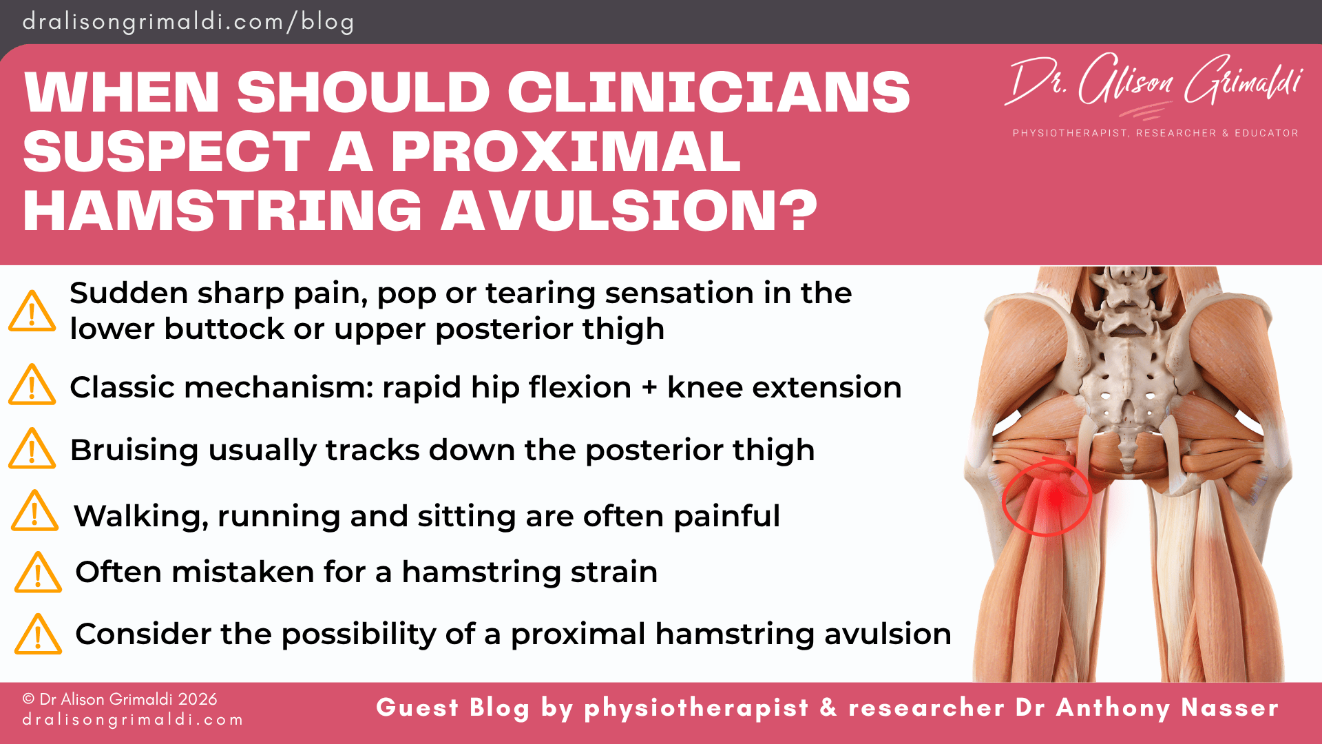 when-should-clinicians-suspect-a-proximal-hamstring-avulsion